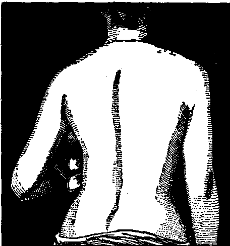 Fig. 104—A tendency toward spinal curvature (after Mosher) Fig. 104