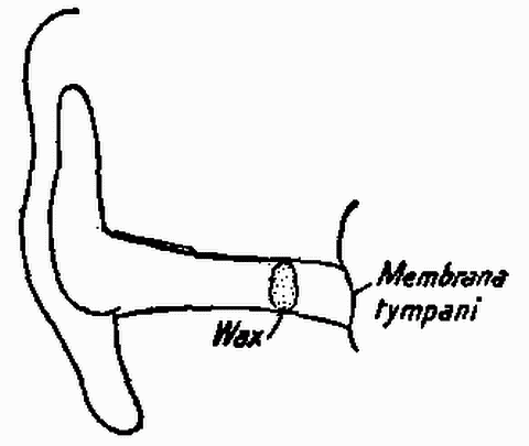 Fig. 155—Diagram showing how wax may plug the auditory canal and cause deafness. Fig. 155