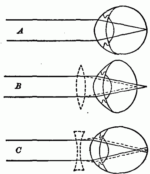 Fig. 164—Diagrams illustrating long-sightedness and short-sightedness, and method of remedying these defects by lenses. A. Normal eye. B. Long-sighted eye. C. Short-sighted eye. Fig. 164