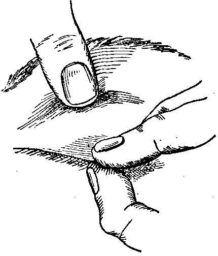 Fig. 165—Method of procedure in lifting the eyelid (Pyle). Fig. 165