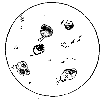 Fig. 172—Consumption germs from the spit of one having the disease. Highly magnified and stained. (Huber's Consumption and Civilization.) Fig. 172