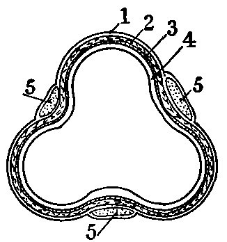 Fig. 74—Section of large intestine, showing the coats. 1. Serous coat. 2. Circular layer of muscle. 3. Submucous coat. 4. Mucous membrane. 5. Muscular bands extending lengthwise over the intestine. Fig. 74