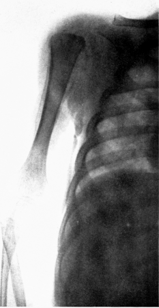 Subperiosteal hemorrhage and separation of epiphysis. Roentgenogram