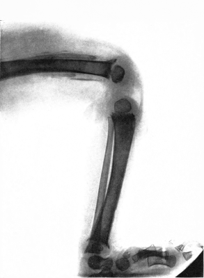 Subperiosteal hemorrhage and separation of epiphysis. Roentgenogram 