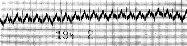 Electrocardiogram showing “cardiorespiratory syndrome”