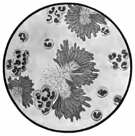 Sputum from a case of actinomycosis