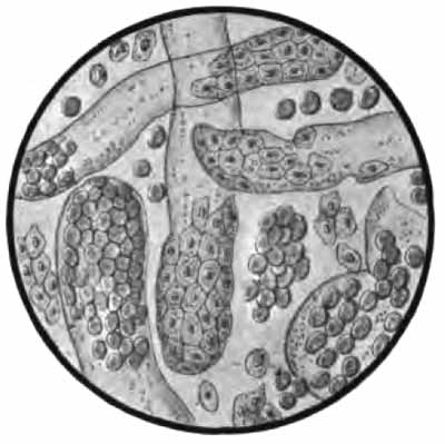 Sediment from acute hemorrhagic nephritis