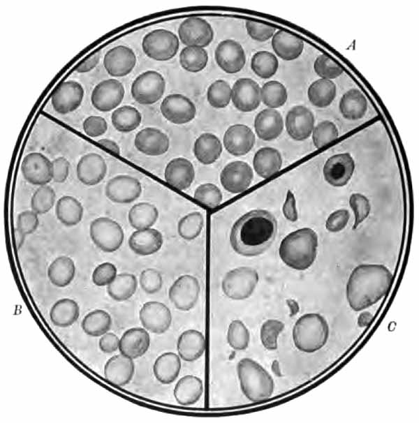 Normal blood, chlorosis, pernicious anemia