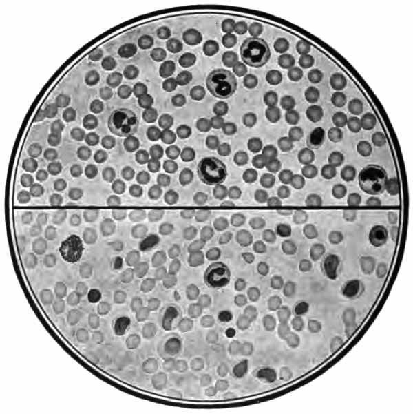 Lymphatic leukemia