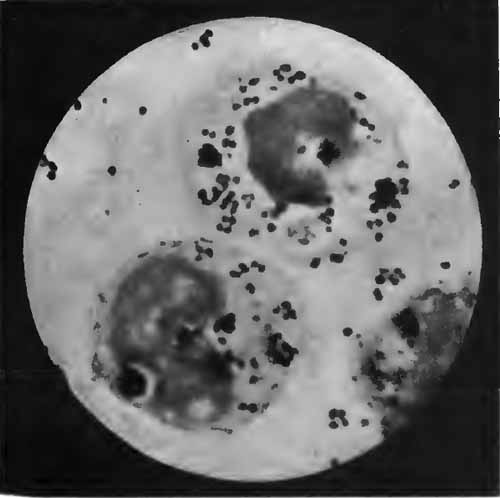 Diplococcus intracellularis meningitidis