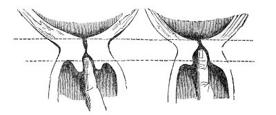 neck of the Womb