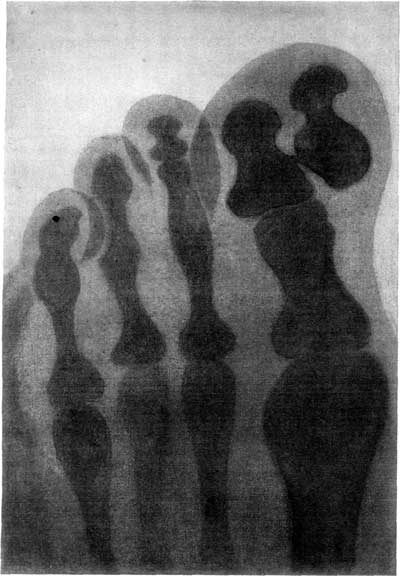 FIGURE 2.&mdash;SKIAGRAPH OF A FOOT, SHOWING AN EXTRA BONE IN THE GREAT TOE.