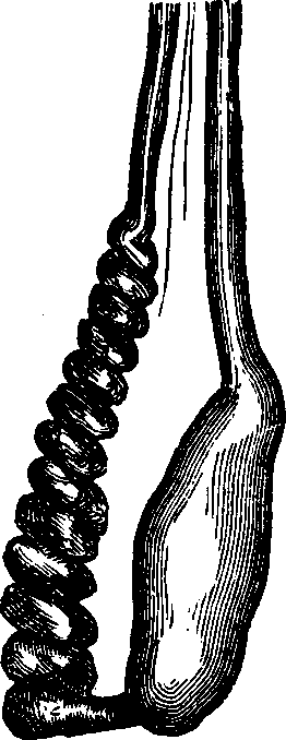 Illustration:
Fig. 2. Testicle wasted from Varicocele. The enlarged and torturous veins
are shown to be about as large as the testicle.