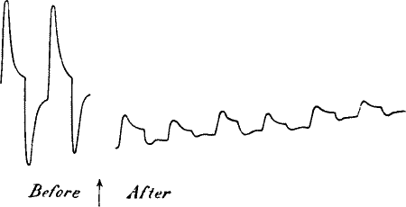 Fig.&nbsp;47.&mdash;Abolition of Response at both A and B Ends by the Action of NaOH
