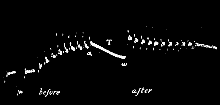Fig.&nbsp;75.&mdash;Abnormal Positive (up) Response in Nerve Converted into Normal (down) Response after Continuous Stimulation T (Waller)