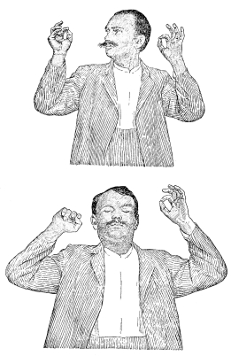Fig. 18.—Visual and Kinesthetic Control of Voluntary
Action: the Former Intact, the Latter Lost.