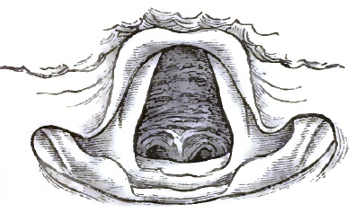 Acute Tracheitis: anterior wall